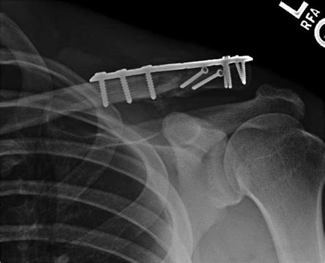 69 Open Reduction and Internal Fixation of Distal Clavicle Fractures | Musculoskeletal Key