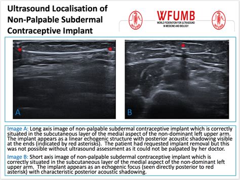 Implantation Ultrasound