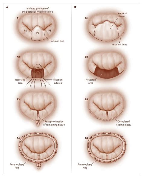 Mitral-Valve Repair for Mitral-Valve Prolapse | NEJM