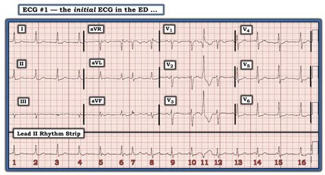 Dr. Smith's ECG Blog: Drug Overdose with a Fascinating Arrhythmia