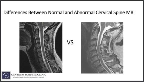 Differences Between A Normal Vs Abnormal Cervical Spine Mri Neck R | My ...