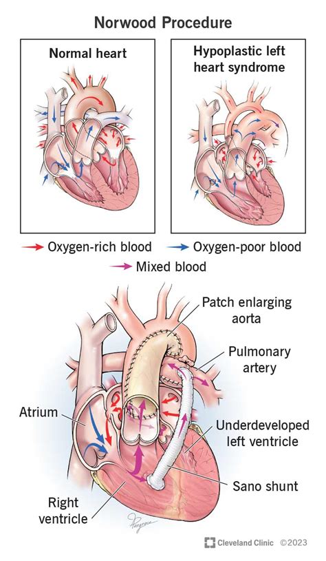 Norwood Procedure: Details, Recovery & Outlook