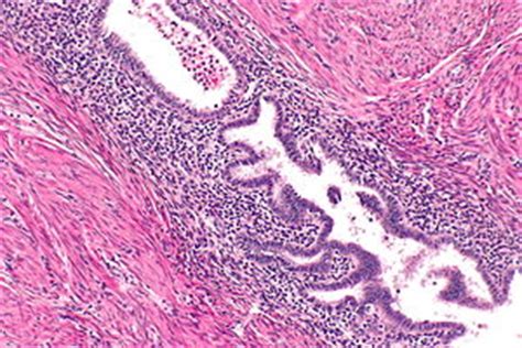 Uterine adenomyosis - Libre Pathology