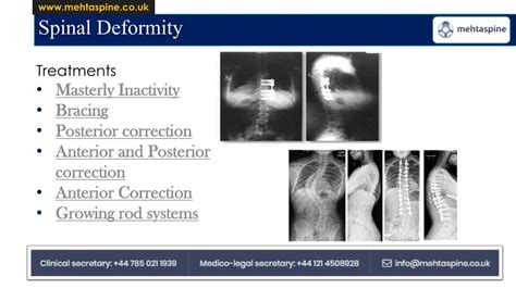 PPT - Dr Jwalant Mehta-Spinal Deformity and treatment - Mehta spine UK ...