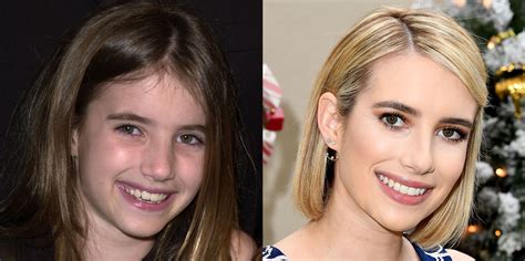 Emma Watson Before And After Braces