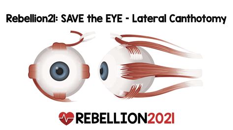 Rebellion21: SAVE the EYE – Lateral Canthotomy via Andy Little, DO – MED-TAC International Corp.