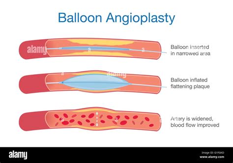 Balloon angioplasty procedure Stock Vector Image & Art - Alamy