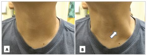 Rare left-sided presentation of internal jugular vein ectasia in an adult | Annals of Saudi Medicine