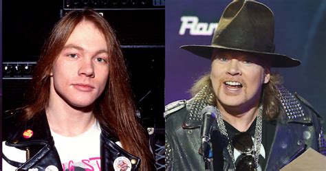 Axl Rose Plastic Surgery Before And After Plastic Sur - vrogue.co