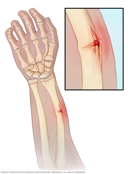 Forearm Fracture Symptoms