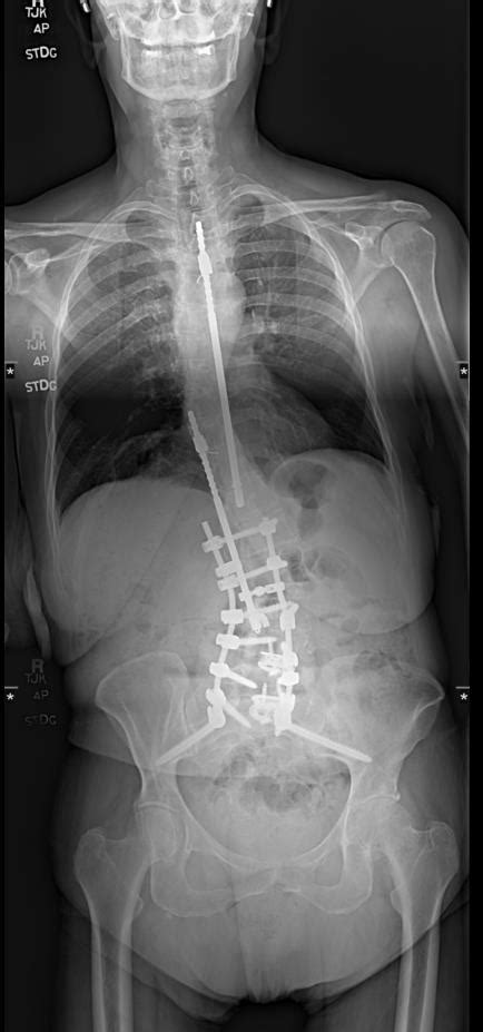 Harrington Rod Extension to the Pelvis and Multilevel Anterior Lumbar ...