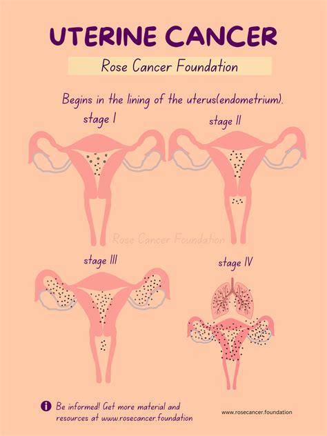 Uterine/Endometrial Cancer