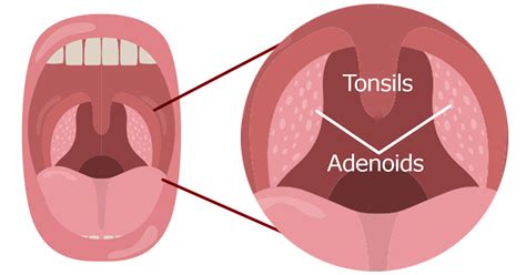 Tonsil And Adenoid Anatomy Tonsils And Adenoids Human Anatomy | The ...