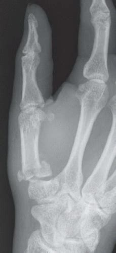 Monteggia Fracture | Radiology Key