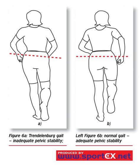 Trendelenburg Sign - Physiopedia