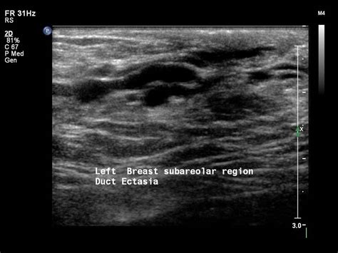 Atlas of breast cancer early detection