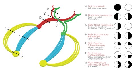 temporal parietal optic radiation - Google zoeken | Internal carotid artery, Nerve anatomy ...