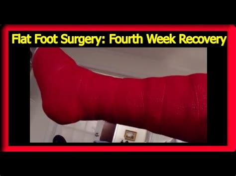 Flat Foot Surgery Recovery: 4th Week Update - YouTube