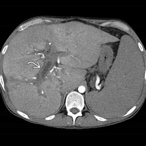 Primary Sclerosing Cholangitis | Radiology Key