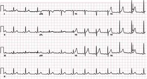 ECG shows sinus rhythm with concave ST elevation (arrows) in leads ...