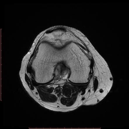 Mucoid degeneration of the ACL | Image | Radiopaedia.org