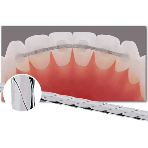 Braided Retainer Wire - Ortho Technology