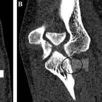 -CT Scan of the left elbow in coronal section in A and B, and in... | Download Scientific Diagram