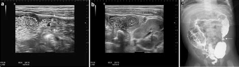 A colonic stricture after NEC of descending colon in a 68 days old male... | Download Scientific ...