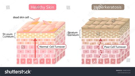 Stratum corneum 498 รายการ ภาพ ภาพสต็อกและเวกเตอร์ | Shutterstock