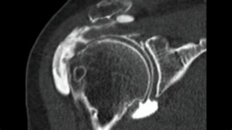 Rotator Cuff Tear Mri Arthrogram - cloudshareinfo