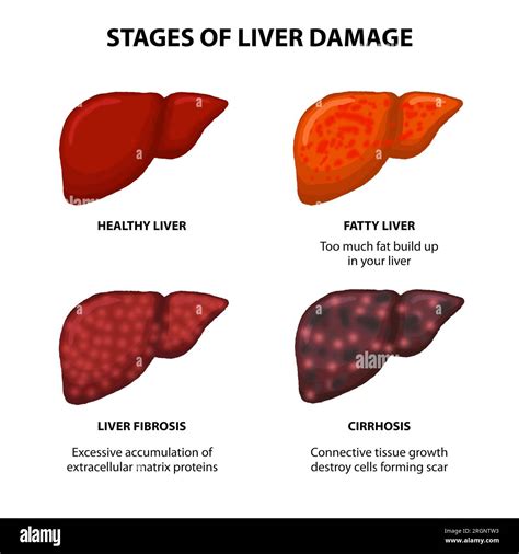 Stages of liver damage illustration Healthy liver, Fatty liver, and liver fibrosis Stock Photo ...