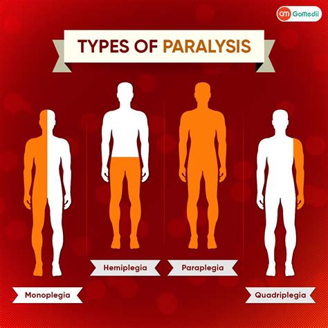 Types of Paralysis