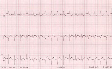 Pedi cardiology: ICU/EKG: Junctional Rhythm, Atrial lead EKG