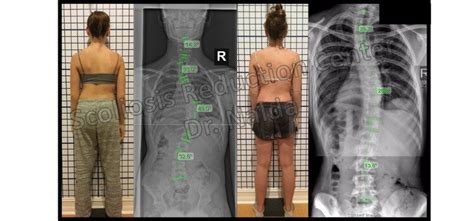 Scoliosis Treatment Results - See Before and After Pictures