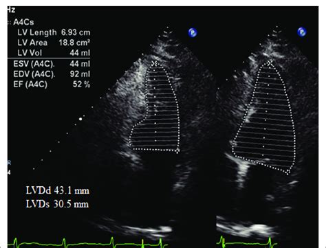 Postoperative echocardiogram showed the LVDd and LVEF improved to... | Download Scientific Diagram