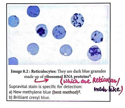 Reticulocytes - Made up of Ribosomal RNA proteins ... Note: Stained by Supravital stain e.g New ...