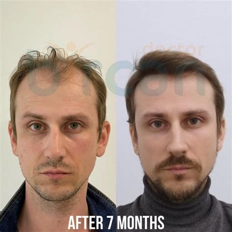 Before After » Dr. Gökhan Bircan