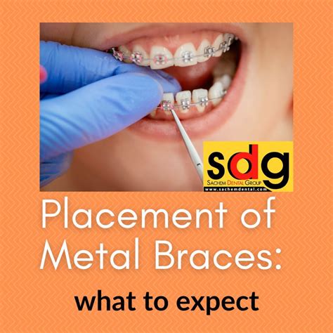 The Placement of Metal Braces: What to Expect