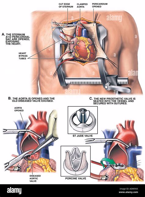 Aortic Valve High Resolution Stock Photography and Images - Alamy