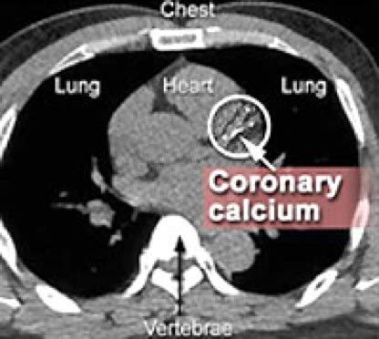 Coronary Calcium Scoring: The Most Advanced Screening Method to ...