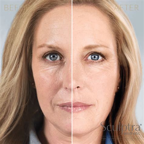 Sculptra Plantation | Lower Face Fillers | Neck Fillers | The Vera Medical Institute