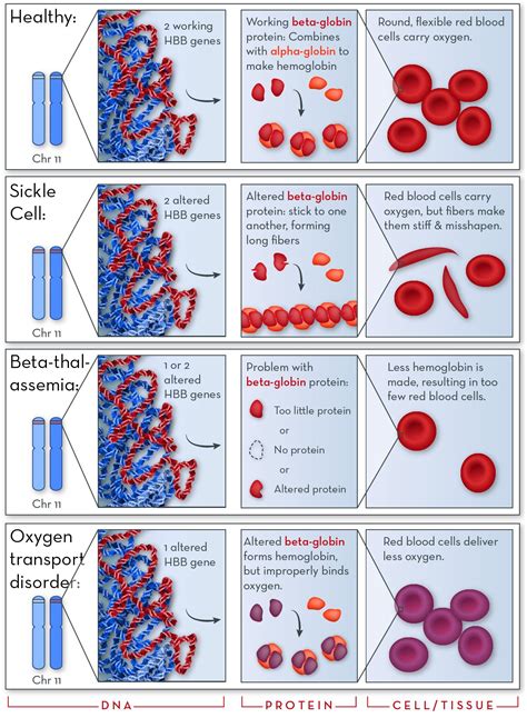 Sickle Cell Disease Hemoglobin C Hemoglobinopathy Hem - vrogue.co