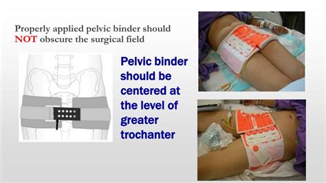 PPT - Fracture Pelvis PowerPoint Presentation, free download - ID:4091721