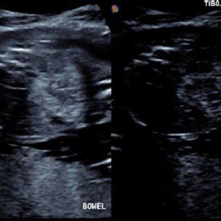 Trans-abdominal US Image Showing Fetal Echogenic Bowel. | Download Scientific Diagram