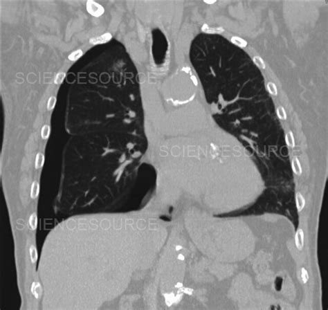 Tension pneumothorax, CT scan | Stock Image - Science Source Images