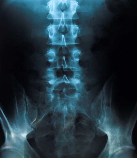 Sacroiliac Joint Injection - LA Orthopedic & Pain Center