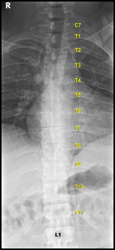 Lateral Thoracic Spine X Ray Positioning