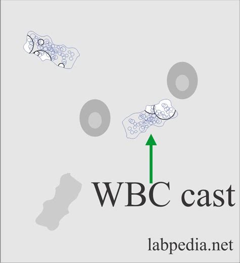 Urine Analysis – part 6 – Urine Analysis, Microscopic Findings and ...