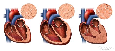 Normal and Unhealthy Hearts - Portfolio - SayoStudio