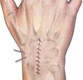 Scapholunate Ligament Repair With Capsulodesis Reinforcement - Journal of Hand Surgery